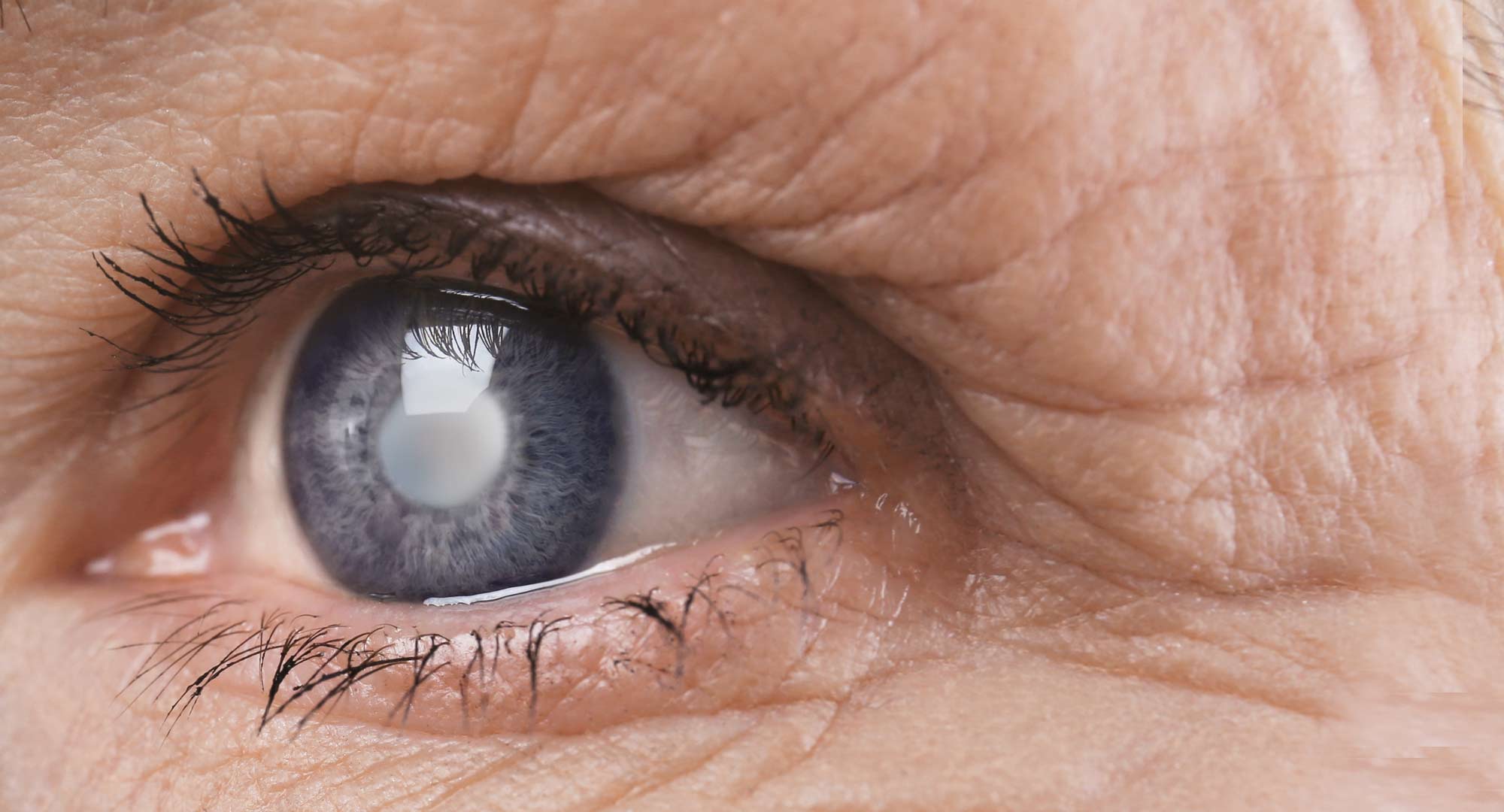 Occhio malato di cataratta, disturbo che annebbia la vista a causa di un’opacità del cristallino