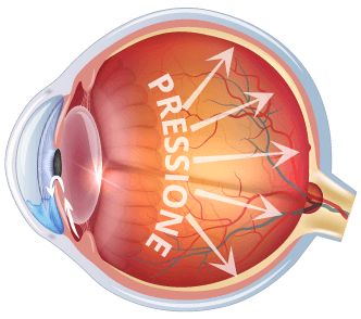 Glaucoma ad angolo aperto, la forma più comune della malattia