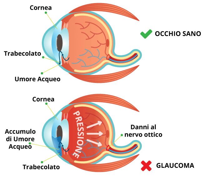 Glaucoma causato da un accumulo di umor acqueo
