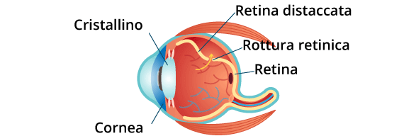 distaccamento e rottura retina