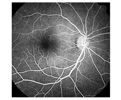 fluorangiografia retinica