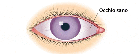 L’uveite è una forma di infiammazione dell’occhio