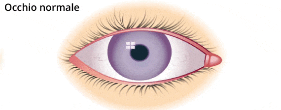 Differenza tra occhio normale e occhio con Pterigio