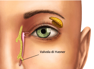 La causa principale del dotto lacrimale chiuso è la mancata apertura della valvola di Hasner