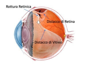 distacco della retina