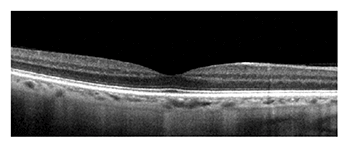 Tomografia a coerenza ottica (OCT) della retina